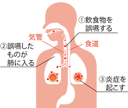 一般的な誤嚥性肺炎発症の図