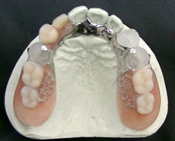 ミニ金属床義歯