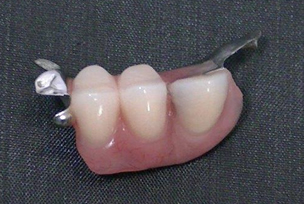 片側中間歯欠損例01